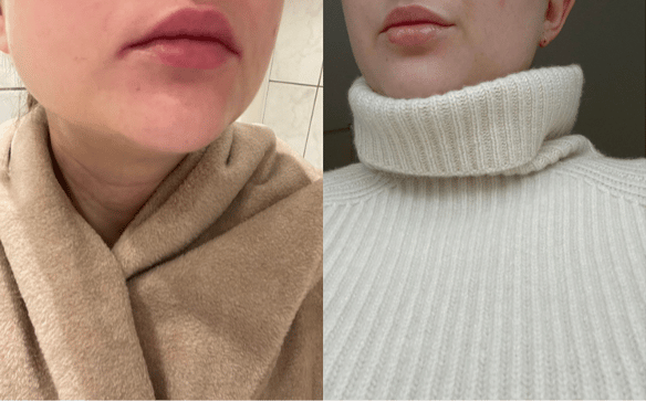 På billedet kan man se, hvor fine og bløde Sille Buchmann's læber er blevet ved brug af Skin & Lip Care. Vidunderbaret